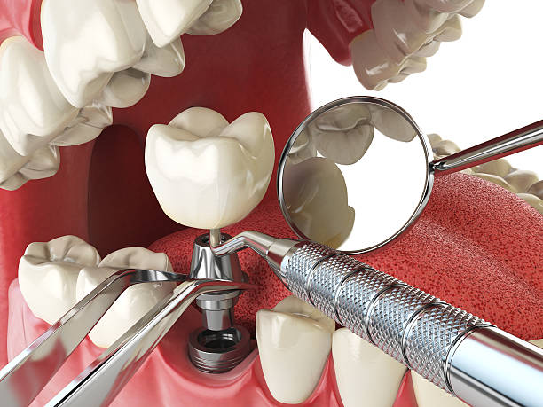 Best Emergency Dental Care for Broken or Chipped Teeth in Ocean City, NJ